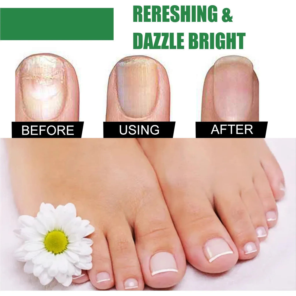 30ml tea tree oil nail care solution bottle for thickened fingernails and toenails