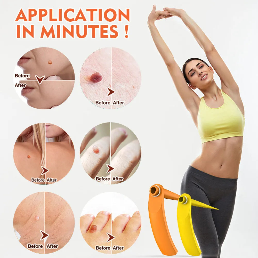 Orange handheld mole removal device with rubber rings, cones, alcohol swabs, and manual