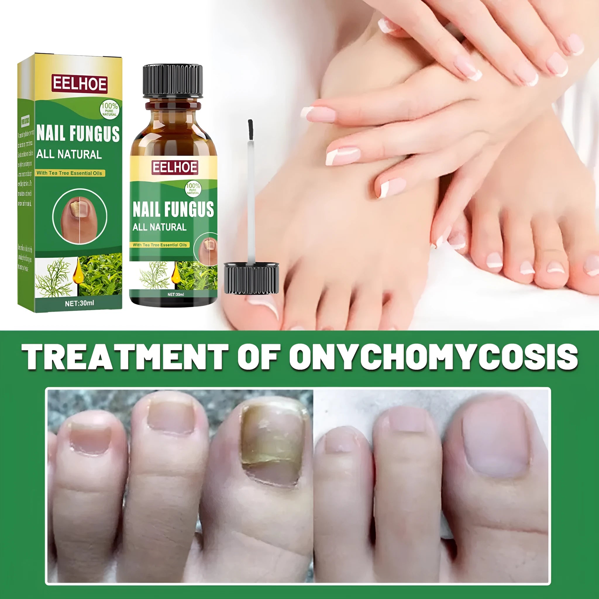 30ml tea tree oil nail care solution bottle for thickened fingernails and toenails
