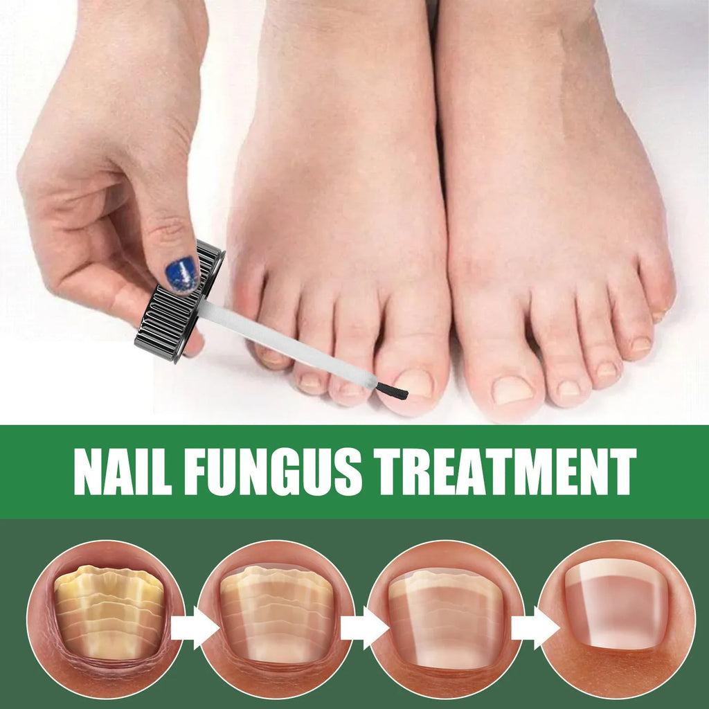 30ml tea tree oil nail care solution bottle for thickened fingernails and toenails